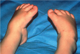 tratamentul comun al degetelor de la picioare