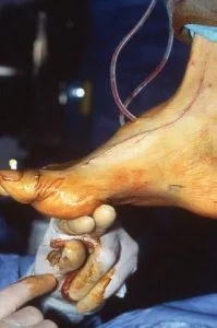 Procedura A.Jones cu legarea halucisului longus extensor în metatarsicul dorsal poate fi de ajutor nu doar pentru căderea labei piciorului, dar și pentru a preveni suferința din cauza presiunii (figura 7).