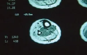 Mușchiul tibial posterior rămâne puternic până în faza târzie a bolii (figura 8).